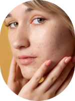 Cosmetis - Acne & Blemishes