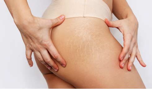 Pregnancy stretch marks