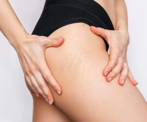 The Best Stretch Mark Creams in 2023